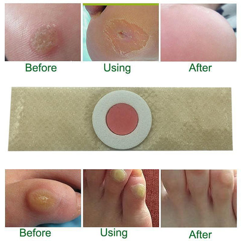 Foot Corn Remover - Foot Corn Remover