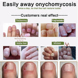 High Quality Nail Growth Cream - Nail Cream