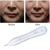 Laser Freckle Removal Pen - Laser Remover