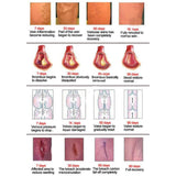 Varicose Veins Treatment Cream - Cream