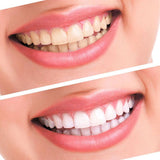 Dental Teeth Bleaching Whitening System - Teeth Whitening
